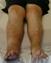 Deep vein thrombosis (DVT) image