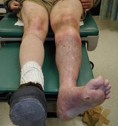 Deep vein thrombosis (DVT) image