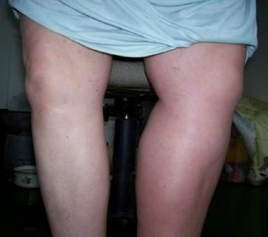 picture of leg swollen from blood clot: DVT survivor Jackie Davis
