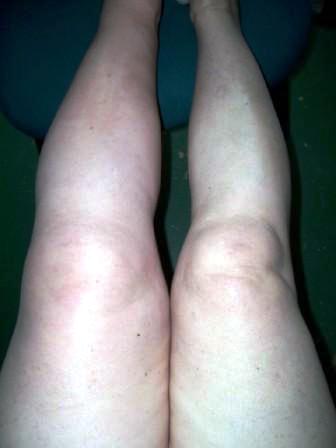 picture of leg swollen from blood clot: DVT survivor Jackie Davis