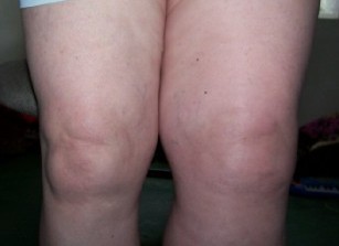 picture of leg swollen from blood clot: DVT survivor Jackie Davis